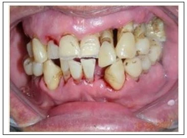 tình trạng nha chu