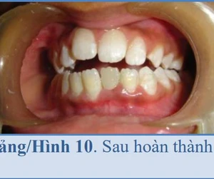 Composit tăng cường sợi: vật liệu chốt và cùi trong răng trẻ em - 218 file