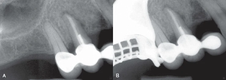 răng đã điều trị