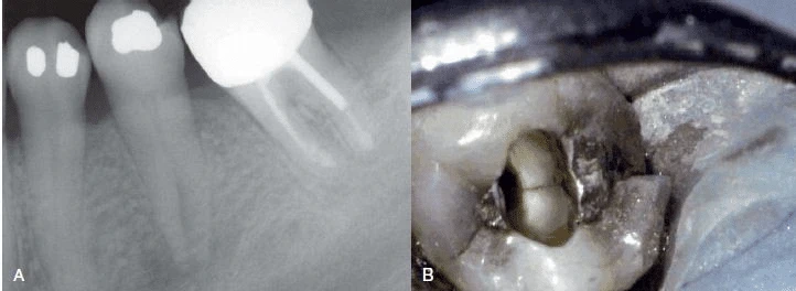 vết nứt răng giữa