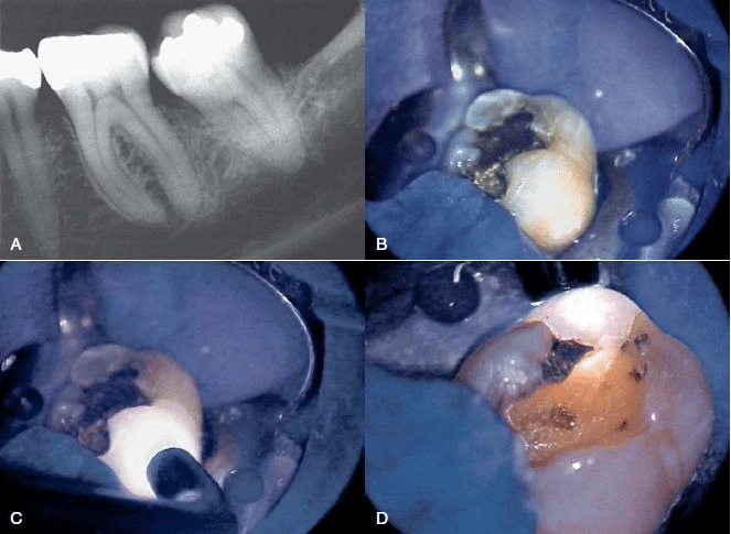 dấu hiệu rõ ràng cho thấy lý do răng có triệu chứng