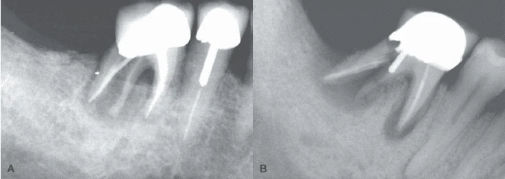 Nứt dọc chân răng dẫn đến chia đôi chân răng 