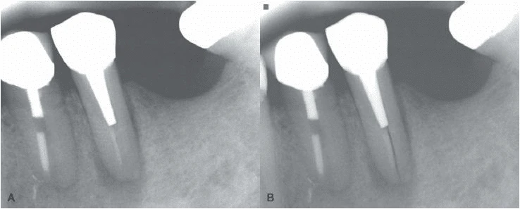 X quang nhưng với một góc chụp đúng thì có thể quan sát rõ đường nứt.