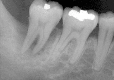 NỨT VÀ GÃY CHÂN RĂNG 6