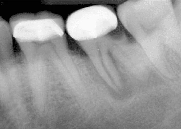 tieu rọng quanh xuong rang