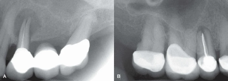 trám bít ống tuỷ và thành ống tuỷ thì nghi ngờ cao có chia chân răng.