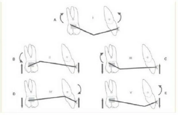 Nguyên tắc bẻ dây dạng V (V-bend Principle)