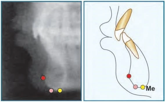 Basion (Ba) Là điểm nằm sau nhất và thấp nhất trên mặt phẳng dọc giữa qua bờ trước lỗ chẩm - đỉnh