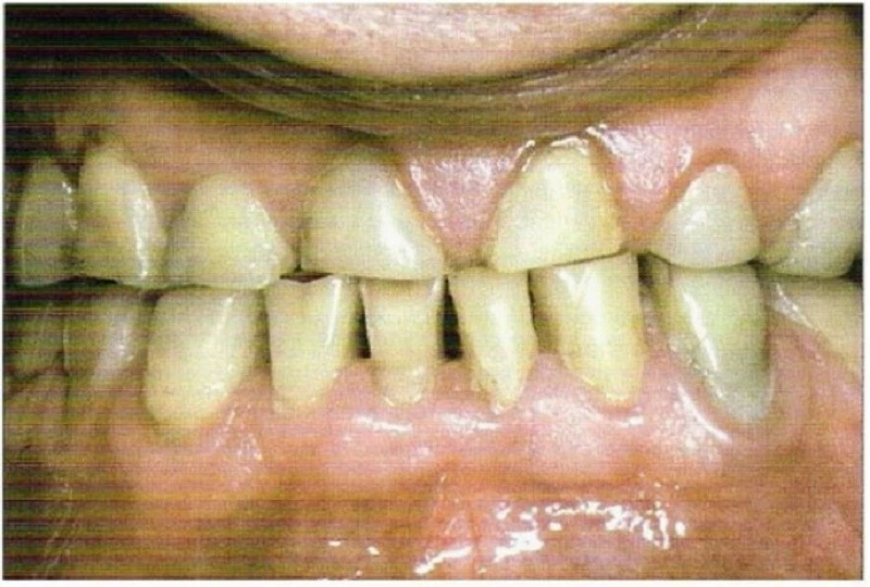 Điểm Bolton (BO) là điểm cao nhất ở đường cong lên của hõm sau lồi cầu.