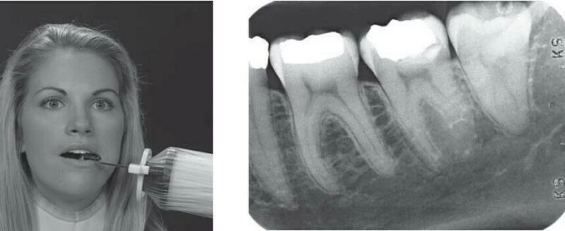 X-quang nha khoa (phần 18) - kỹ thuật chụp - 32ca10 d53214278f8b458fbca40b44db0a9784mv2