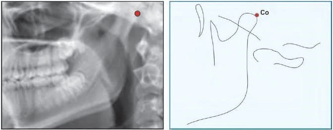 Giao điểm của mặt dưới nền sọ và mặt sau của cổ lồi cầu xương hàm dưới