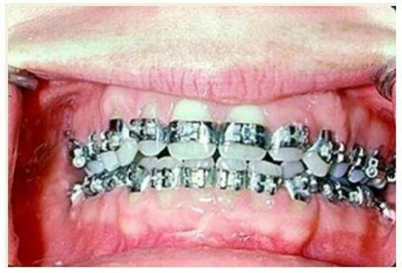 Có một hình ảnh có hình giọt nước, bóng phía trước là mặt sau của lồi cùng xương hàm trên.