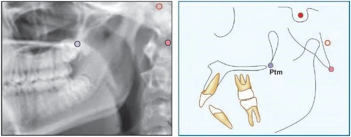 Đôi khi do khó xác định porion nên sử dụng đỉnh của bóng thanh tai