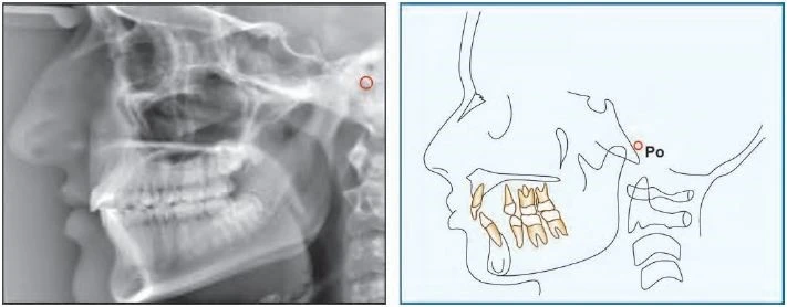 nên sử dụng đỉnh của bóng thanh tai