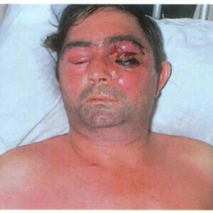 Viêm nhiễm phần mềm vùng miệng - hàm mặt (phần 1) - 3 file