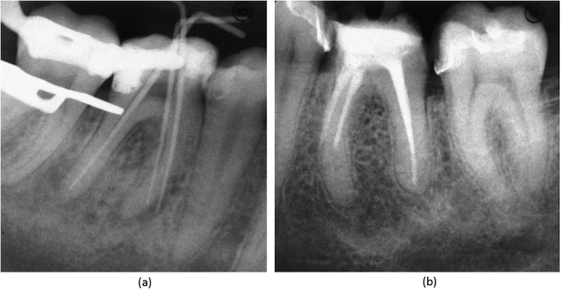 sự tạo khấc bằng vị trí ban đầu