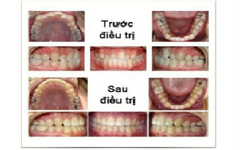 Nhổ răng cửa dưới