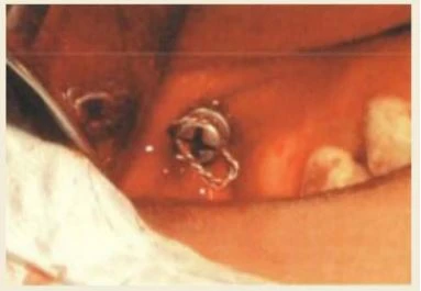 bệnh nhân nhận ra răng của họ quá vẩu