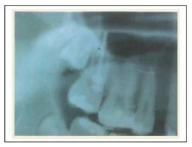 răng bệnh nhân chen chúc