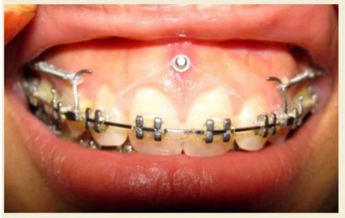 SERIES TỰ HỌC CHỈNH NHA: TỔNG QUAN VỀ CÁC TRƯỜNG HỢP KHÔNG NHỔ RĂNG Khí cụ Frankel