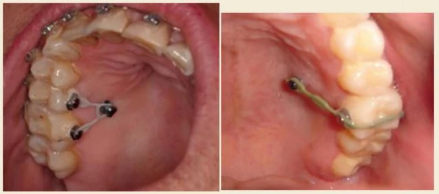 Rapid Palatal Expander(RPE)