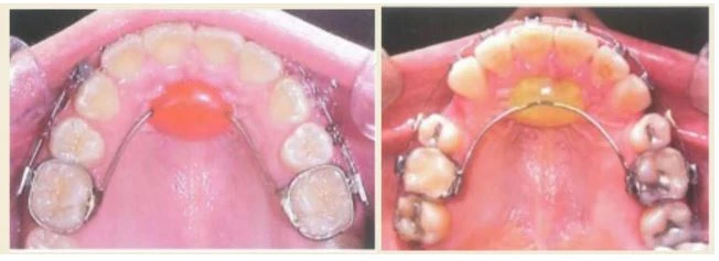 SERIES TỰ HỌC CHỈNH NHA: TỔNG QUAN VỀ CÁC TRƯỜNG HỢP KHÔNG NHỔ RĂNG QuadHelix