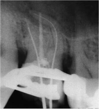 trâm nhỏ có thể uốn theo hình dạng ống tủy