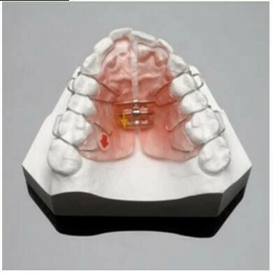 SERIES TỰ HỌC CHỈNH NHA: TỔNG QUAN VỀ CÁC TRƯỜNG HỢP KHÔNG NHỔ RĂNG Hàm nong Schwarz trên