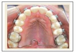 SERIES TỰ HỌC CHỈNH NHA: TỔNG QUAN VỀ CÁC TRƯỜNG HỢP KHÔNG NHỔ RĂNG Headgear