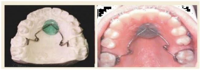 Cung di xa Wilson - Wilson Distalizing Arch
