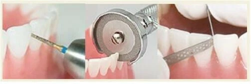 Ngăn nhổ răng cửa dưới (nên thường không nhổ răng).