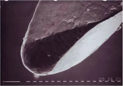Sự dịch chuyển ống tủy trong điều trị nội nha