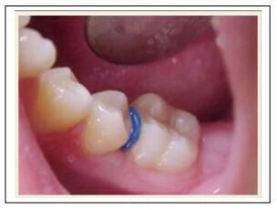 Series tự học chỉnh nha: Neo chặn tối thiểu dây SS tròn