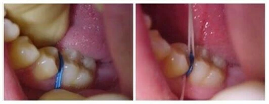 Series tự học chỉnh nha: Neo chặn tối thiểu Bẻ trên dây tròn