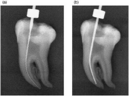 sửa soạn ống tủy bị dịch chuyển nhẹ