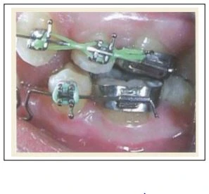 dây cung hàm dưới ở những bệnh nhân Class III cùng với sử dụng mắc chun Class III