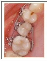 Series tự học chỉnh nha: Neo chặn tối thiểu neo chặn tối thiểu hiệu quả nhất