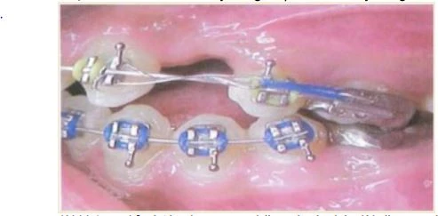 Series tự học chỉnh nha: Neo chặn tối thiểu răng hàm hở