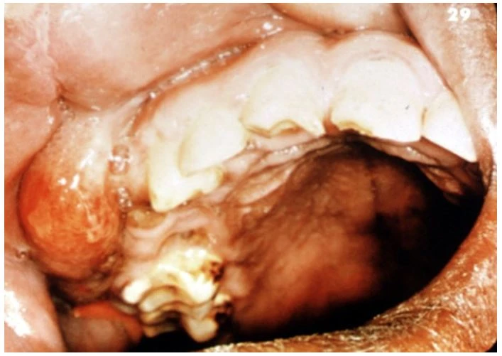 Viêm nhiễm phần mềm vùng miệng - hàm mặt