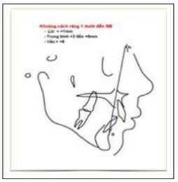 Viêm nhiễm phần mềm vùng miệng - hàm mặt viêm nhiễm