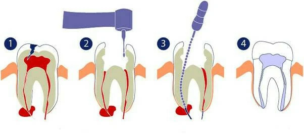 độ chặt của chất trám ống tủy
