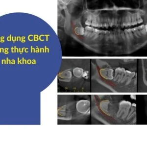 Vì sao tôi yêu CBCT - ứng dụng trong thực hành (phần 1) - ANH HIEN TREN WEBSITE