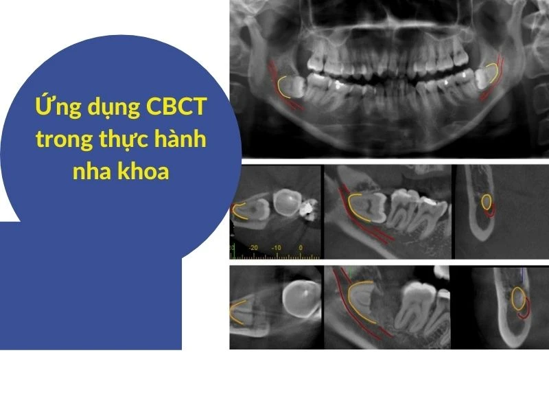 Vì sao tôi yêu CBCT - ứng dụng trong thực hành (phần 1) - ANH HIEN TREN WEBSITE