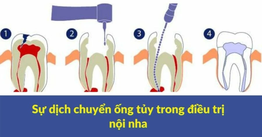 Sự dịch chuyển ống tủy trong điều trị nội nha