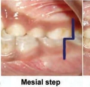 Sự phát triển bộ răng: giai đoạn răng sữa từ mầm đến mọc hoàn chỉnh - D09698 01dc8fbf1ce942b09eee1c3ebc831712mv2