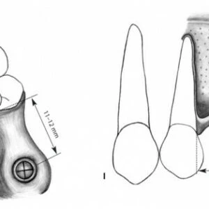 Những nguyên tắc cơ bản khi phẫu thuật Implant – chuẩn bị - D09698 4a6bab87b9e6411da57e18c807ddb554mv2
