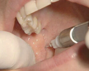 Các kỹ thuật gây tê trong điều trị tủy răng – phương pháp truyền thống - D09698 6e2cfb74d41f418690f2b7e0c4d81935mv2