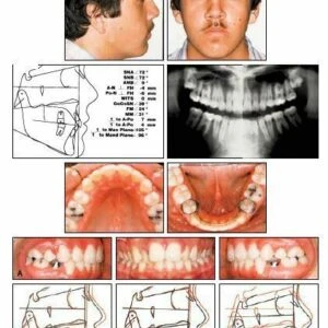 VTO nha khoa: phân tích sự di chuyển răng trong chỉnh nha (phần 2) - D09698 807498b2ef724f67a978e500253ec8e3mv2