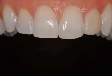 So màu răng và gửi thông tin cho labo: kỹ thuật và quy trình chuẩn - D09698 a991cd9ac65d49bea355c1bf4f9e4148mv2