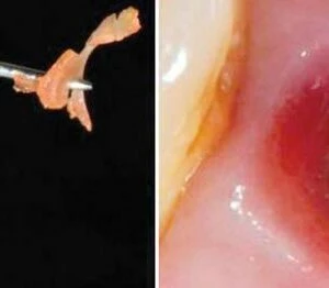 Lời khuyên để phục hình trên Implant đạt kết quả tốt nhất - D09698 c252073c8f3b445ab7955f5d32a60864mv2